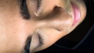 جراحی سخت ترین بینی به طبیعی ترین شکل ممکن