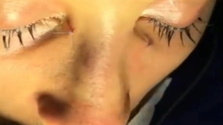 بینی بلافاصله بعد از عمل