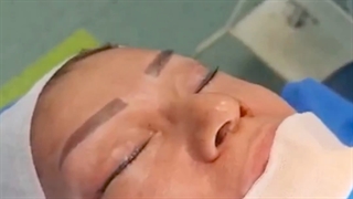 جراحی لیفت کامل صورت