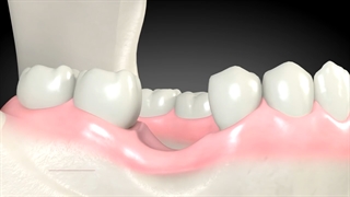 پیوند استخوان برای ایمپلنت دندان | کلینیک بارانا