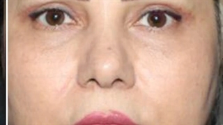 دیگه وقتش شده با افتادگی چشمات خداحافظی کنی با جراحی بلفاروپلاستی توسط دکتر دای