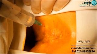 عمل جراحی شقاق به روش اسفنکتروتومی