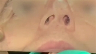 نتیجه اصلاح عدم تقارن سوراخ های بینی