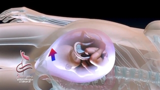 زایمان سزارین