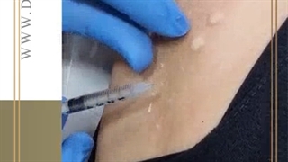 بوتاکس زیر بغل