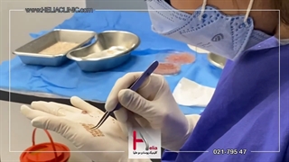 جدیدترین روش کاشت مو با بانک موی ضعیف