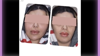 لیفت صورت با تزریق چربی
