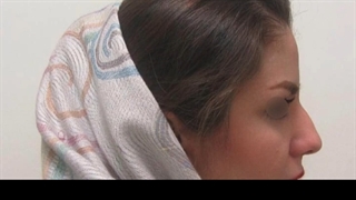 جراحی زیبایی بینی قوزدار