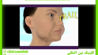 جوانسازی صورت ترمیم لبخند لثه‌ای