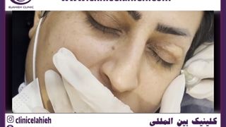 کربوکسی تراپی