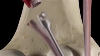 آرتروسکوپی