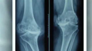 تجربه بیمار از جراحی تعویض مفصل زانو