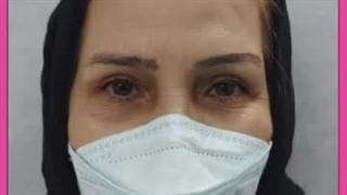 محل برش ها در بلفاروپلاستی پلک بالا و پایین