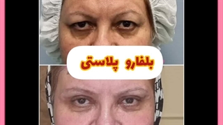 جراحی پلک پف دار اردبیل