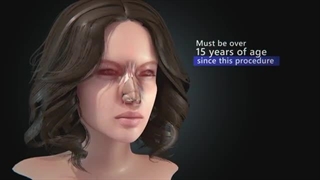 Rhinoplasty (Nose Job) | Step by step