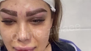 کاشت ابرو در کلینیک آرتین