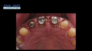 پریدگی و ترک در پرسلن قسمت سوم