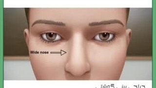 جراحی بینی گوشتی