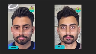 نمونه کار فیلر زاویه فک