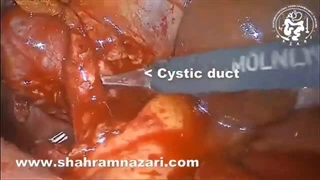 Laparoscopic cholecystectomy / LCBD Exploration/ CBD Stenting in sclerosing cholangitis