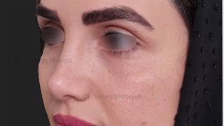 عمل زیبایی بینی