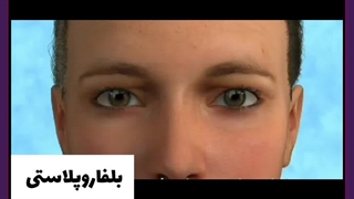 زمان بهبودی بخیه بلفاروپلاستی