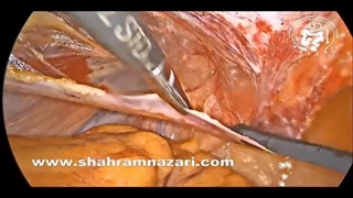 ترمیم لاپاروسکوپیک فتق کشاله ران با مش