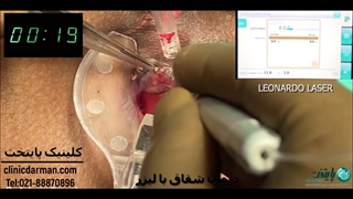 لیزر شقاق و فیشرکتومی | کلینیک پایتخت