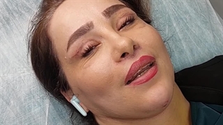 بلفاروپلاستی غبغب سانترال در کلینیک آرتین