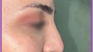 جراحی لیفت بینی