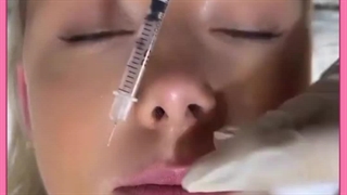 عوارض تزریق ژل و بوتاکس ترمیم لبخند لثه‌ای