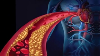 دلیل بالا شدن چربی خون چیست علایم چربی خون بالا و درمان چربی خون بالا در خانه