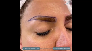 نتیجه‌ای شگفت‌انگیز! کاشت ابرو طبیعی با تراکم بالا