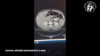 انوکلاسیون نوروآندوکرین تومور سر پانکراس