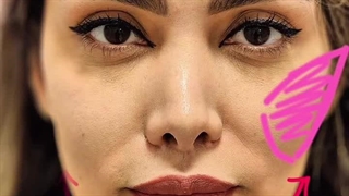 فیلر گونه کلینیک آوینا