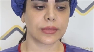 کاشت ابروی سوپر نچرال در کلینیک زیبایی رنسانس