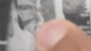 فیلم عمل جراحی دیسک کمر